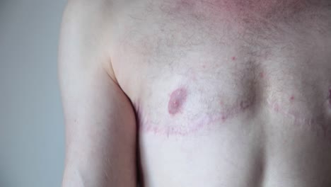 transgender man showing surgery scars on chest