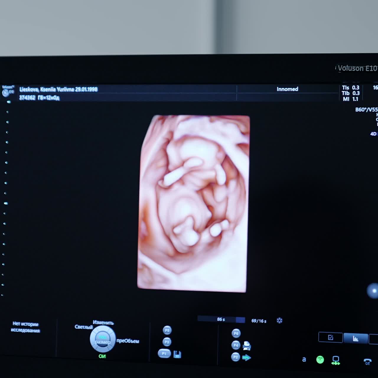 3d image of a baby in the mother's womb. Screen of ultrasonic equipment during examination of pregnant woman. Close up