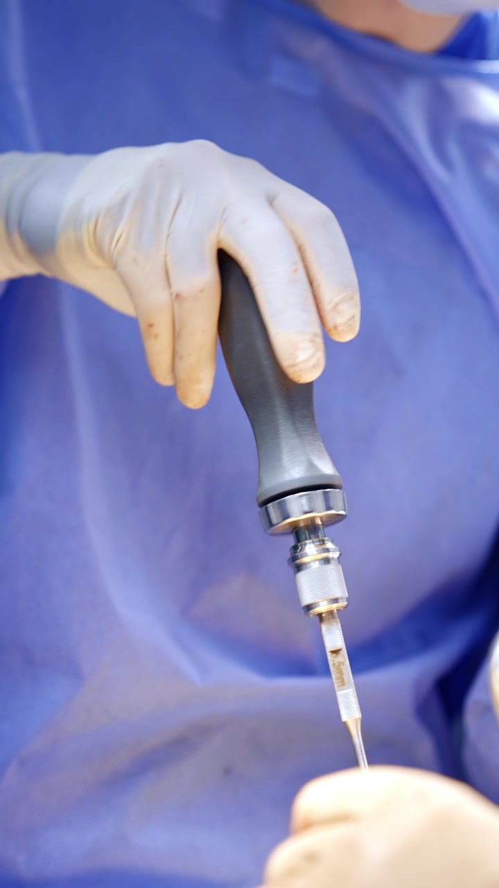 La mano del medico con guanti in lattice usa un cacciavite chirurgico. Applicazione dello strumento medico durante l'operazione, primo piano. Video verticale.