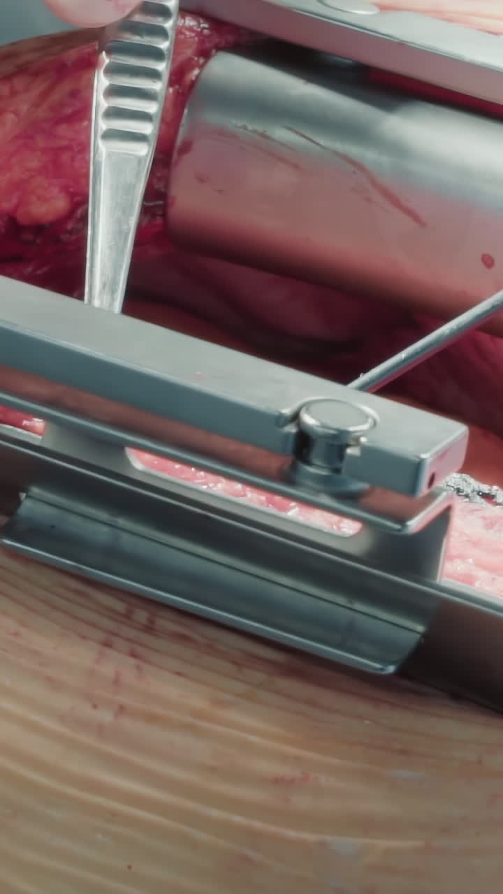 외과 의사는 레이저 스칼펠을 사용하여 심장을 개방합니다. 외과의사는 고정된 초점을 맞추는 무성 환경에서 관상 동맥을 탐색하기 위해 미세한 포세프를 사용합니다.