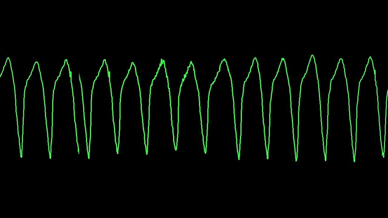 ecg는 심실 타키아르디 (vt) 를 나타니다.
