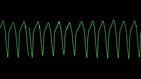 ecg shows ventricular tachyardia (VT)