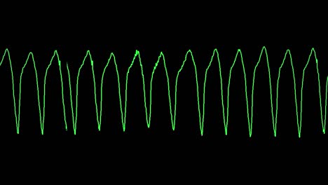 ecg shows ventricular tachyardia (vt)