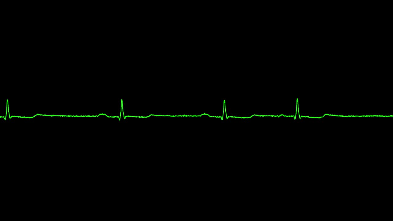 экг показывает синусовую брадикардию