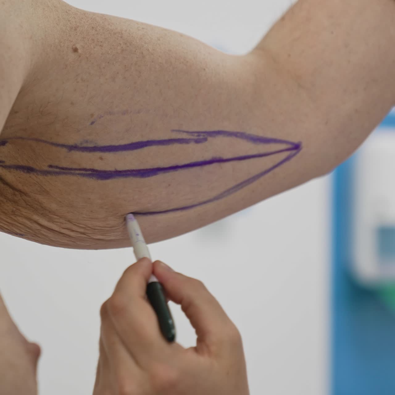 Plastic surgeon marking places on patient's body before the body lifting. Doctor drawing signs with a marker on a patient's arm before the surgery. Close-up