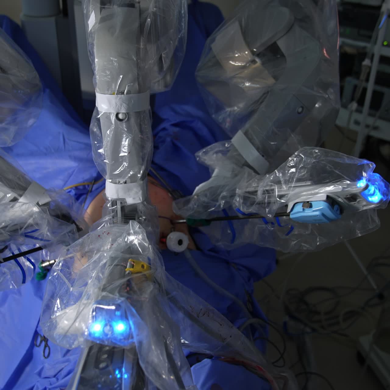 Massive robotic manipulator arms moving over the patient at laparoscopic surgery. Da Vinci robot operating the patient's abdomen. Top view