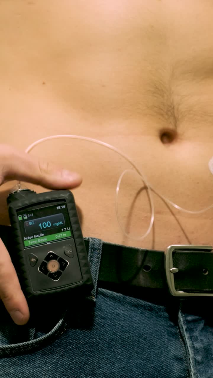 Person sætter insulinpumpe fast til bælte til diabetesbehandling