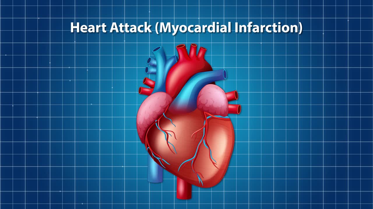 Illustrated animation of a heart attack, showing plaque buildup and artery blockage in a detailed, educational style