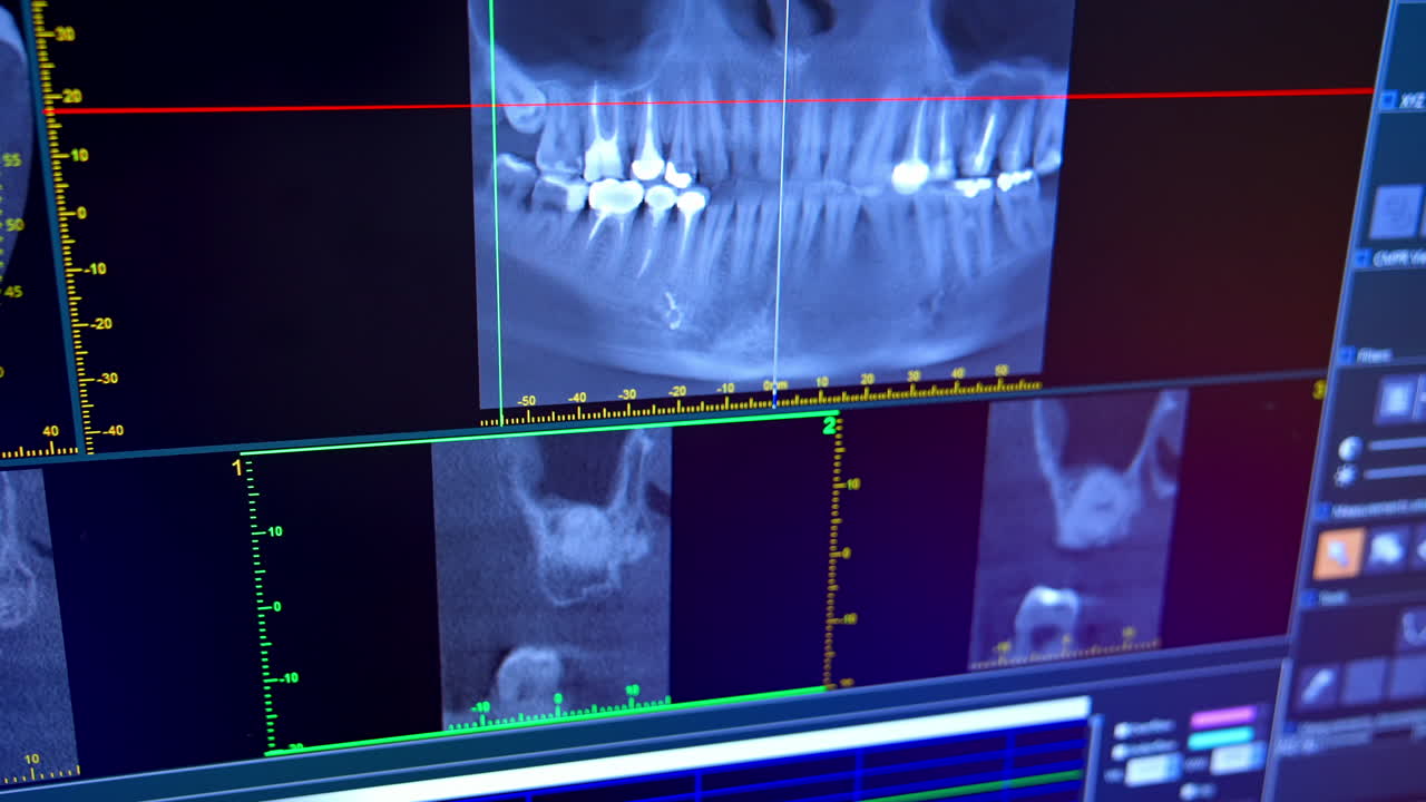 X-ray of oral cavity with teeth. Close up of digital orthopantomography for dental diagnosis