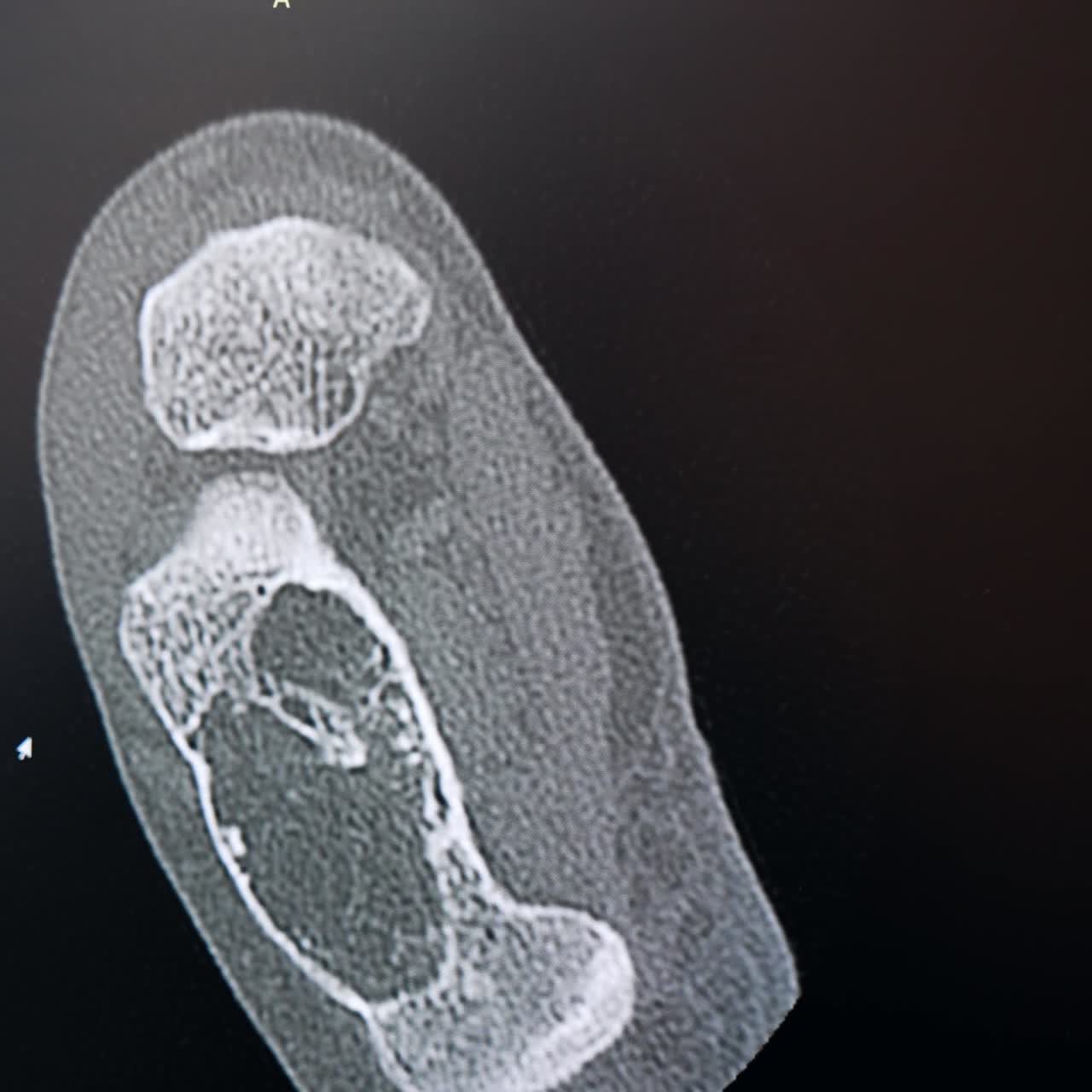 Uno sguardo più ravvicinato alla risonanza magnetica di una parte del corpo sullo schermo nero. Preparazione per un intervento chirurgico in ospedale. Primo piano.