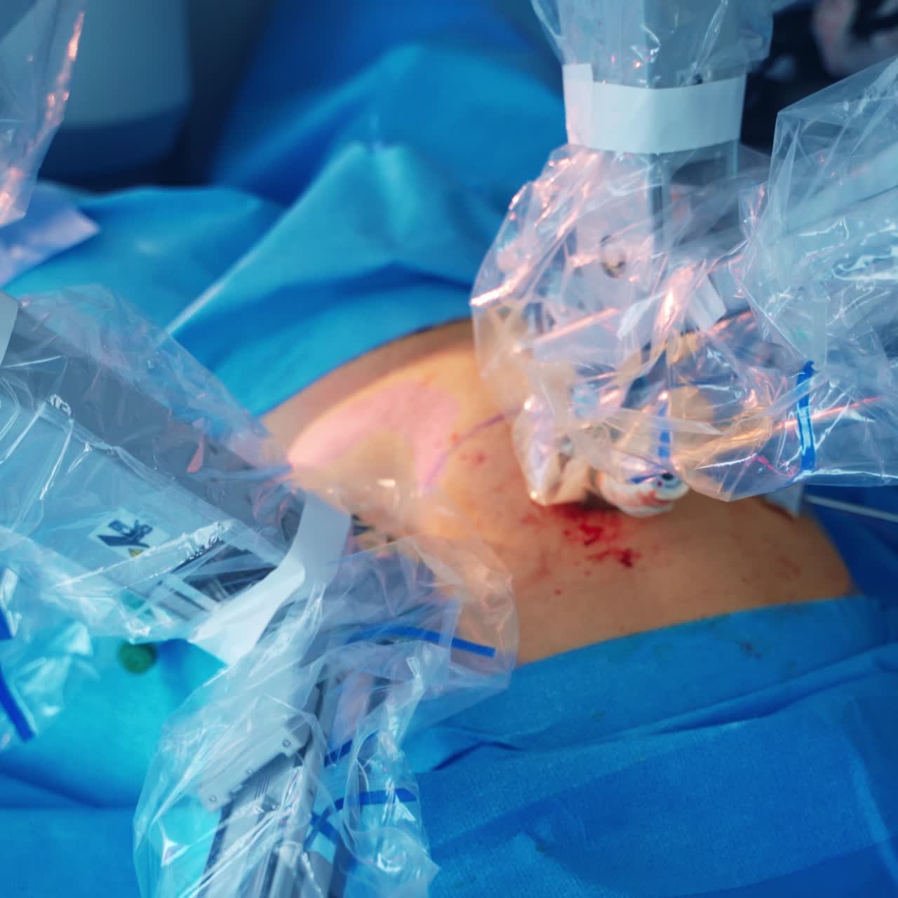 Modern surgical system. Medical robot. Minimally invasive robotic surgery.