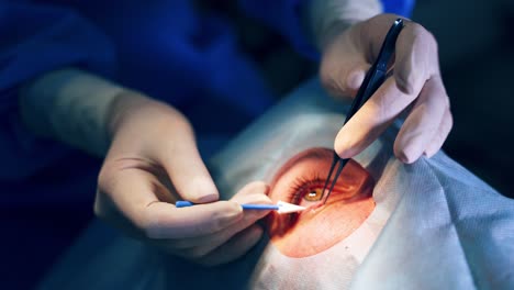 ophthalmology operation. surgeon's hands in gloves performing eye vision correction. modern clinic and equipment. selective video focus.