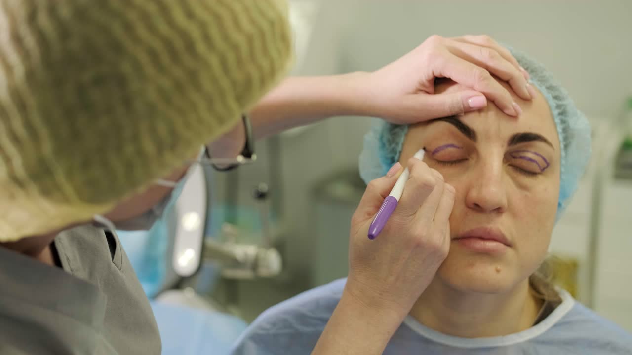 marcado de blefaroplastia en los párpados. el médico prepara al paciente para la cirugía plástica en el área del ojo
