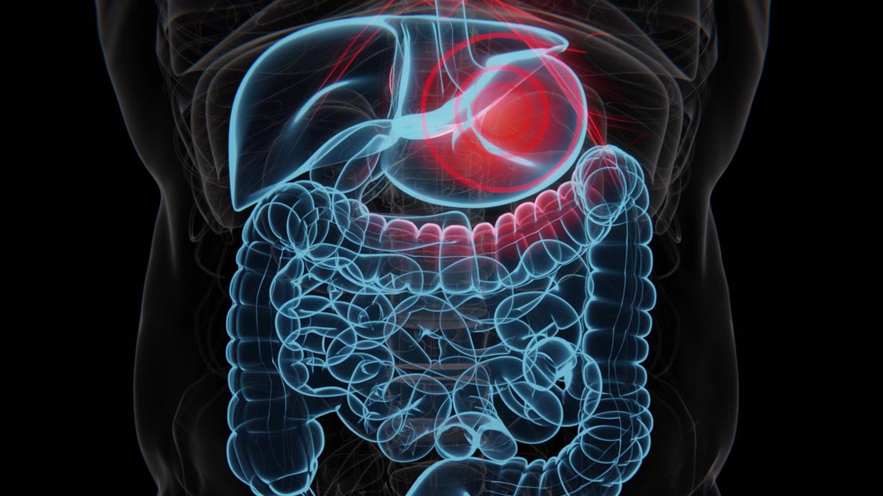 Acid reflux is a digestive condition in which stomach acid flows back into the esophagus, causing a burning sensation, chest discomfort, or irritation | Acid reflux indication Video in 4K UHD