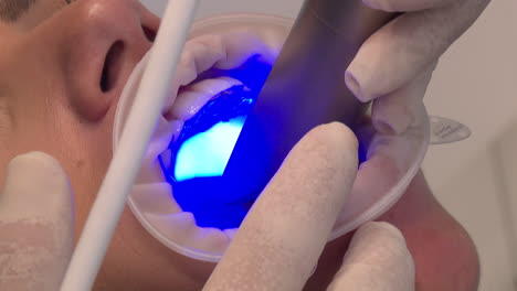 procedimiento dental con luz azul