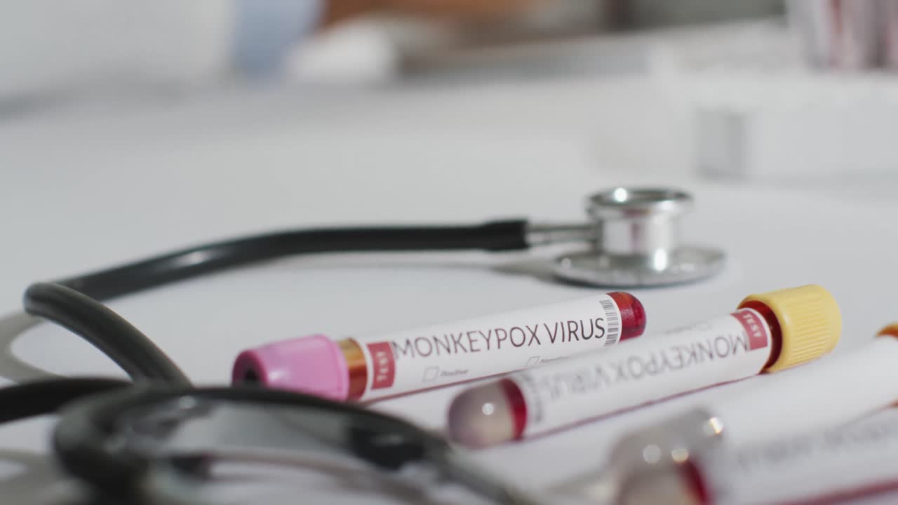 Vials with monkeypox virus and stethoscope over african american male doctor using laptop