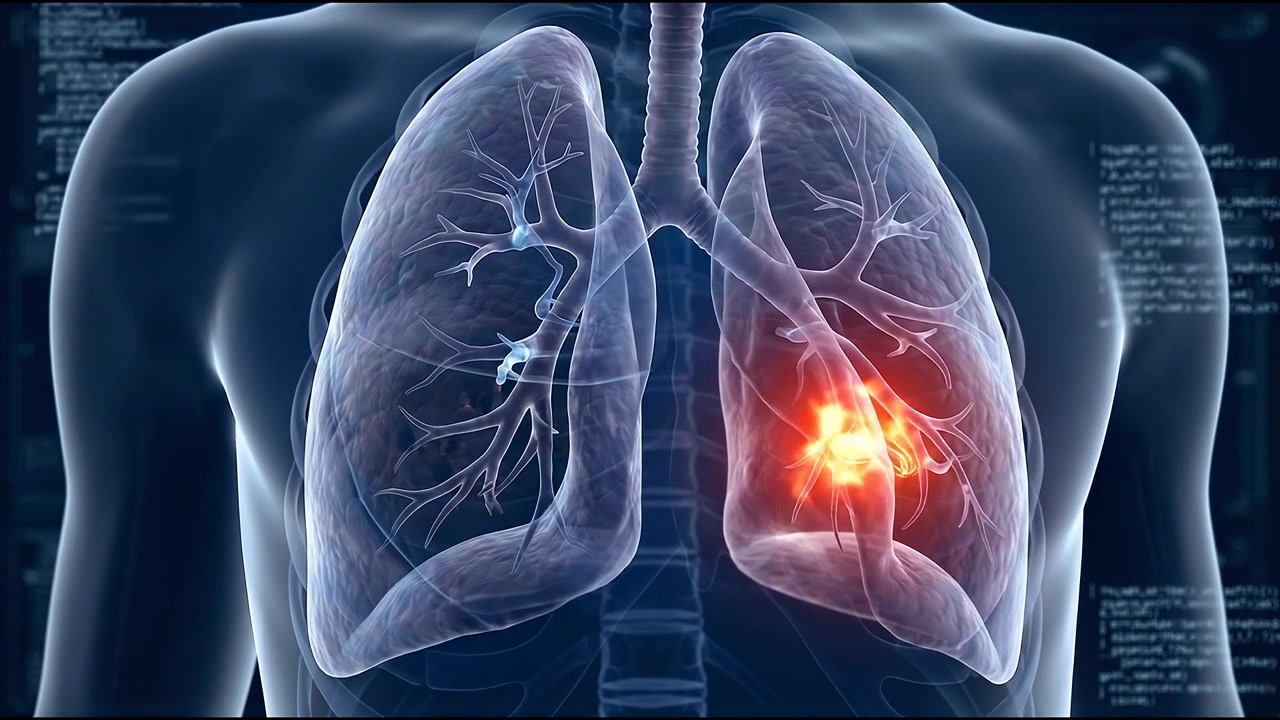 Animazione Medica della Progressione della Malattia Polmonare