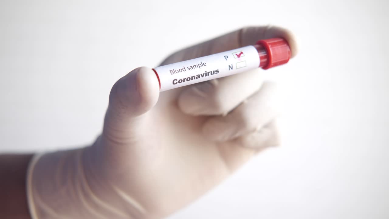 muestra de sangre para la prueba de coronavirus