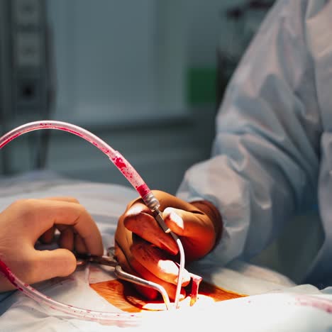surgical procedure. hands of surgeon in sterile gloves operating patient with medical tools. medical pipes with blood in the operating room. close-up.