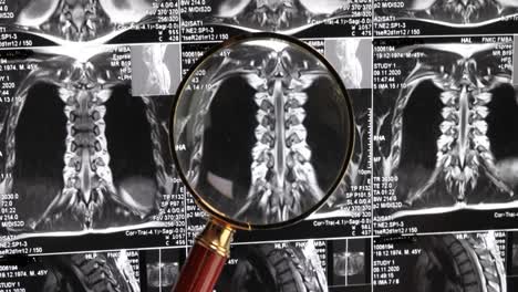resonancia magnética de fondo de la columna lumbar, tomografía por resonancia magnética. el médico examina la resonancia magnética de la columna lumbar con discos pellizcados de la columna vertebral y los nervios.