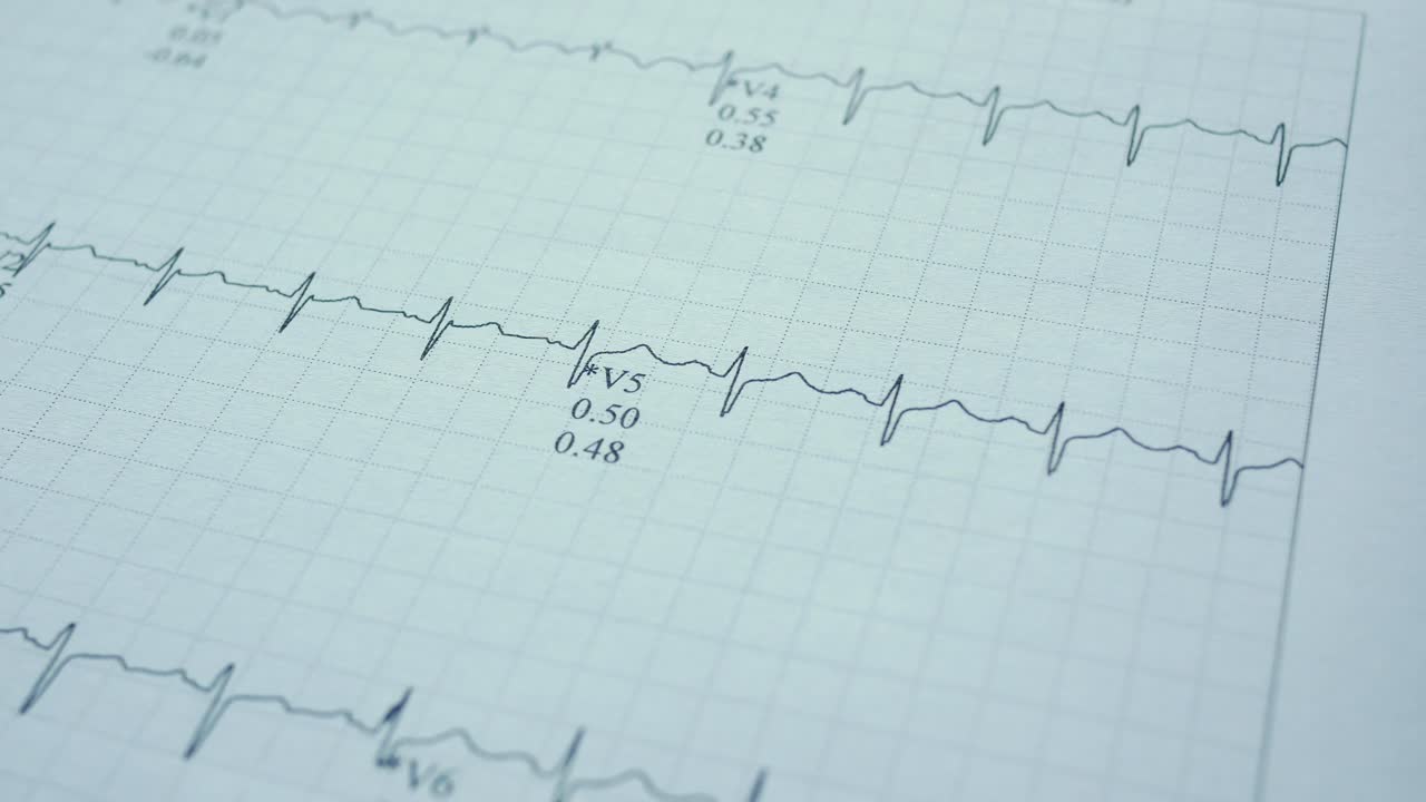 imágenes de electrocardiograma (ecg)