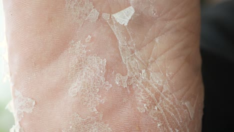 발의 건조하고, 어지고, 벗겨지는 피부: 원인과 치료