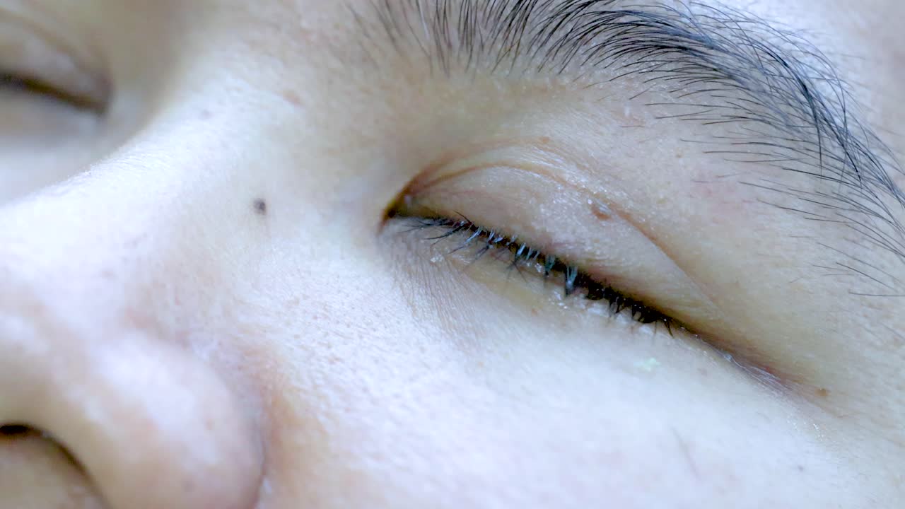 Macro view of irritated, inflamed eye with redness and tears, under bright, clinical lighting
