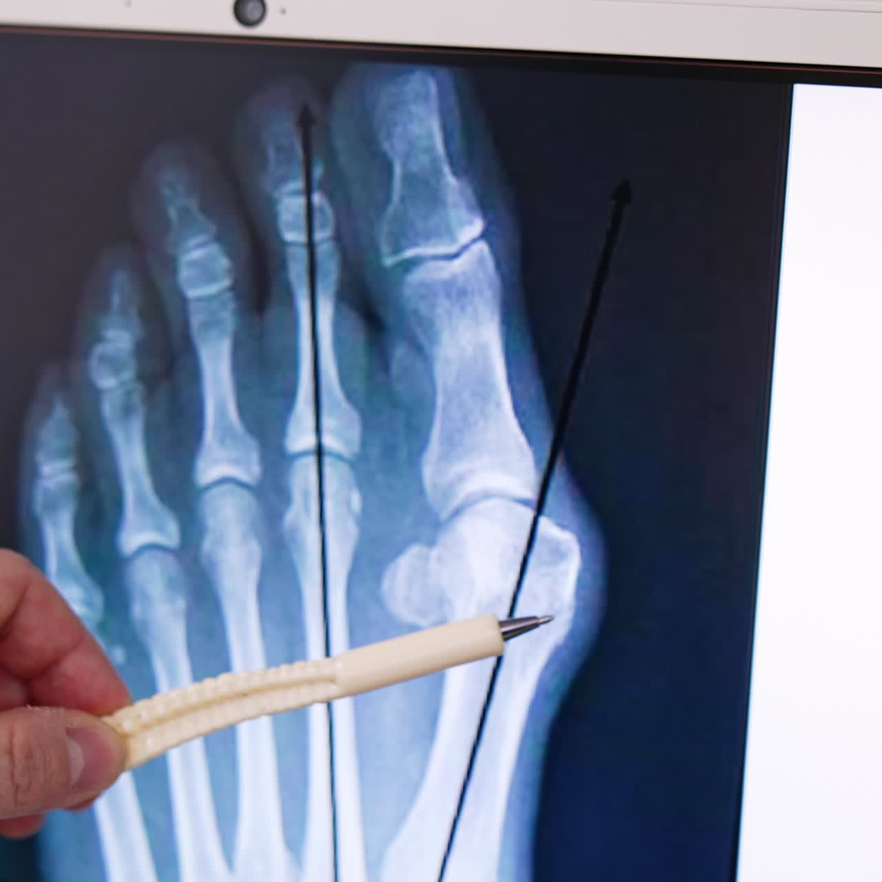Male hand holding a pen and moving it by the x-ray scan of a foot. Surgeons are getting ready to perform operation on the limb