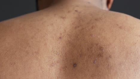 back skin condition with scarring