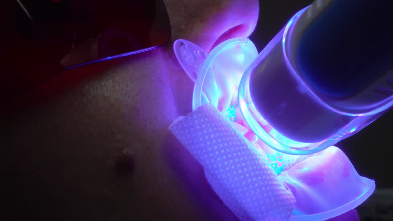 UV Whitening Teeth - An ultra violet whitening machine closeup in operation on a patient's teeth. Shot in 4k