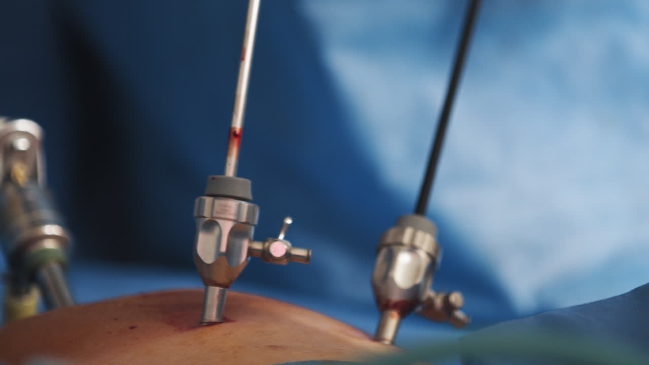 라파로스코피 수술 절차