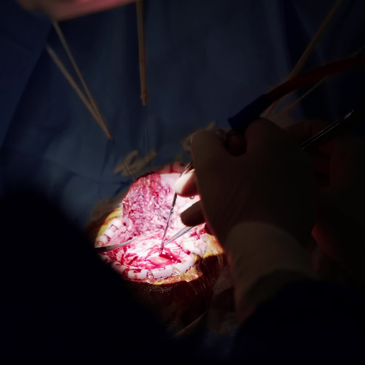 Internal organ during surgery in darkness. Hands of a doctor with surgical tools operate the patient. Close-up.