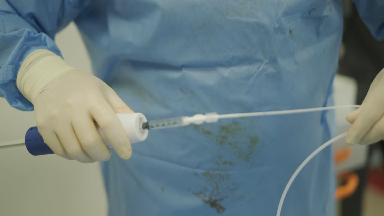 herida de úlcera en la pierna en el tratamiento de venas varicosas en el procedimiento de flebología. unión de venas con pegamento biológico