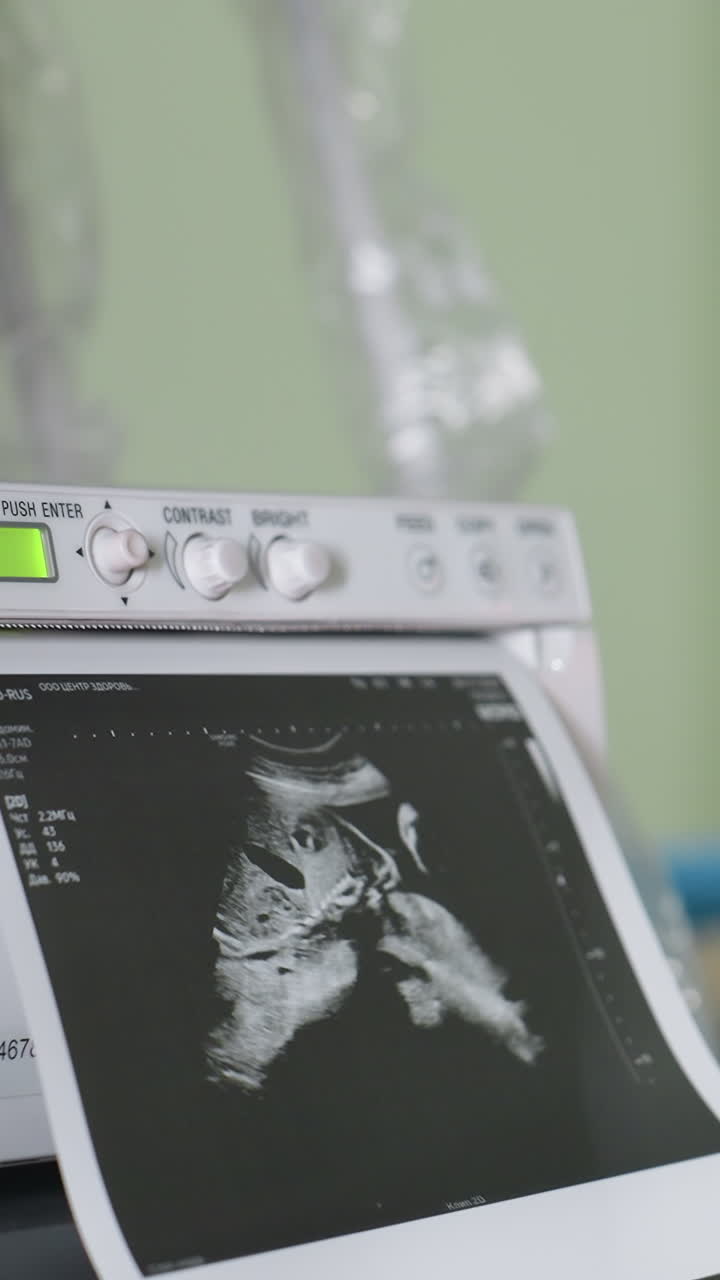 산부인과 초음파 검사 중 검진대 위에 누워 있는 흰색 옷을 입은 임산부의 클로즈업, 탐침을 조작하는 초음파 기사, 모니터에 보이는 초음파 사진 인쇄물, 눈물이 글썽거리고 희망에 찬 표정을 짓는 환자