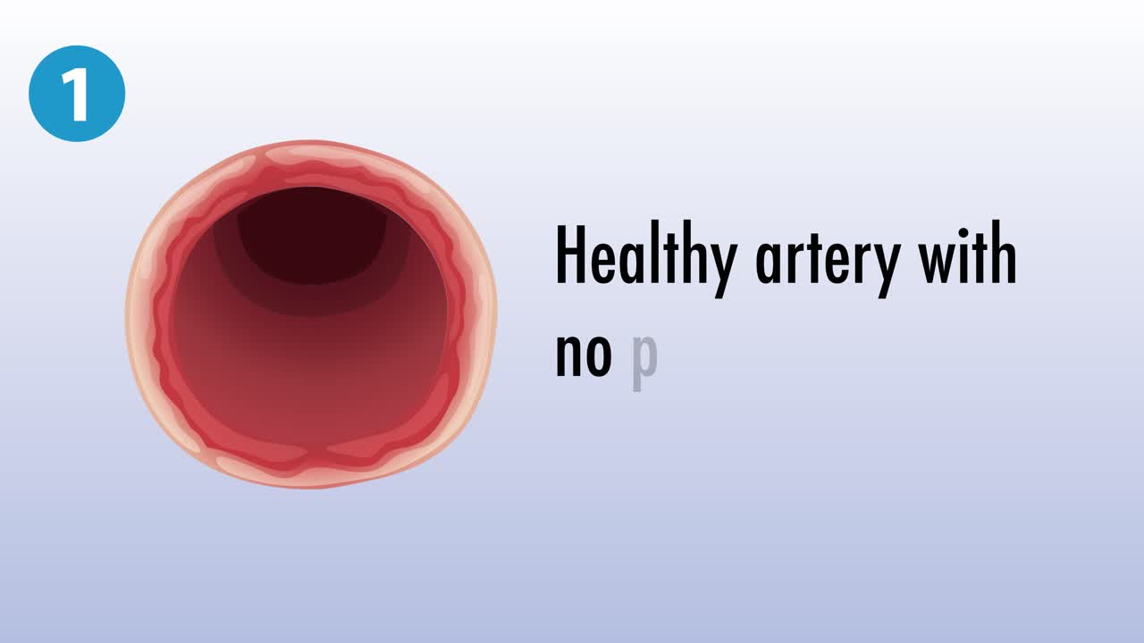 Visualizing stages of atherosclerosis in an artery
