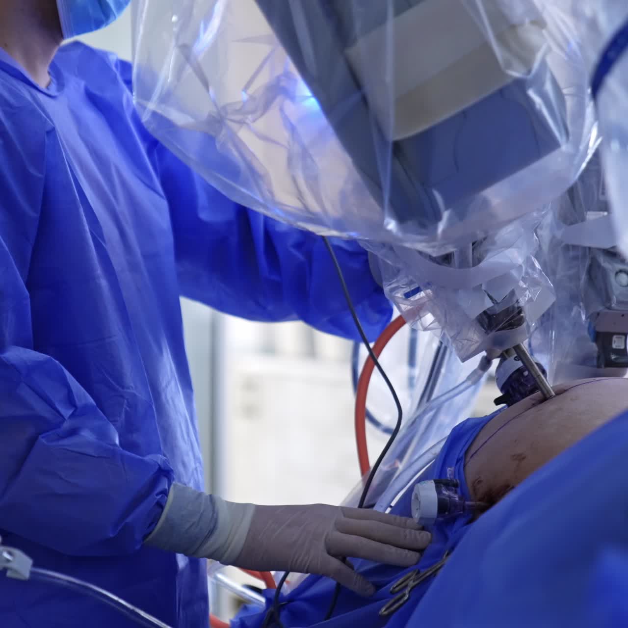 Cropped image of the surgeon standing by the patient. Robotic equipment arm input into abdomen