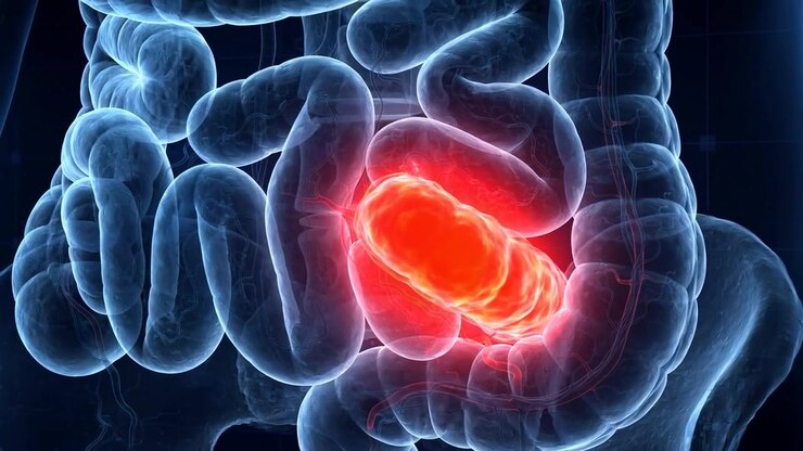 X-ray style 3D visualization of human intestines with a red glowing inflamed segment in the lower left abdomen showing bowel pain