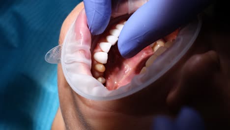 dentist performing a dental procedure on a patient