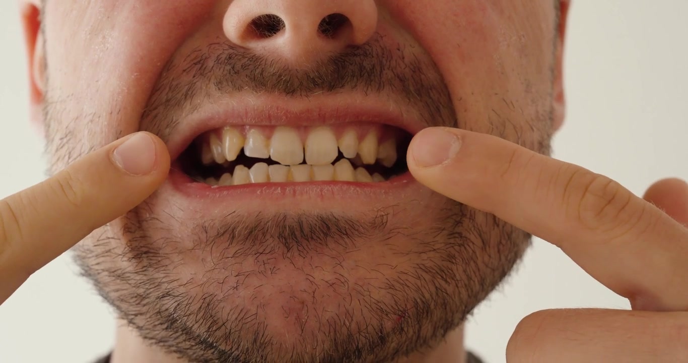 Primo piano di un uomo che indica denti macchiati o gialli, evidenziando la discromia dentale e le preoccupazioni per l'igiene orale.