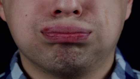 close-up of a person's mouth with lip sores