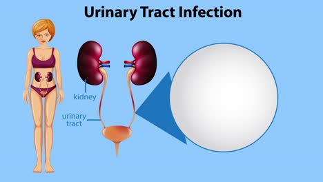 illustration of uti development and bacterial presence