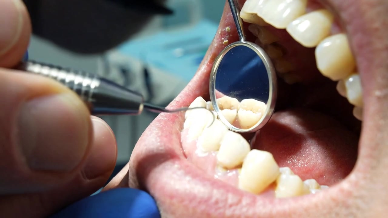 Dentist Performing Dental Cleaning on Patient