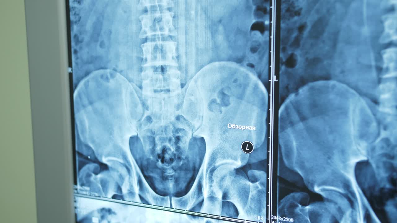 detailed close-up on X-rays of the spine and pelvis.