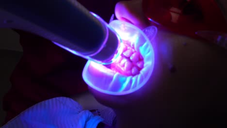 vista en primer plano de una mujer joven recibiendo blanqueamiento uv en el consultorio del dentista por una máquina ultravioleta. filmado en 4k