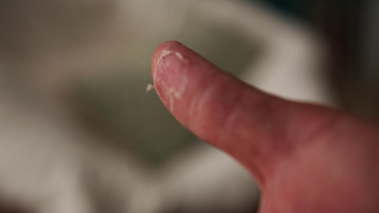 Person finger damaged by blister, close up view