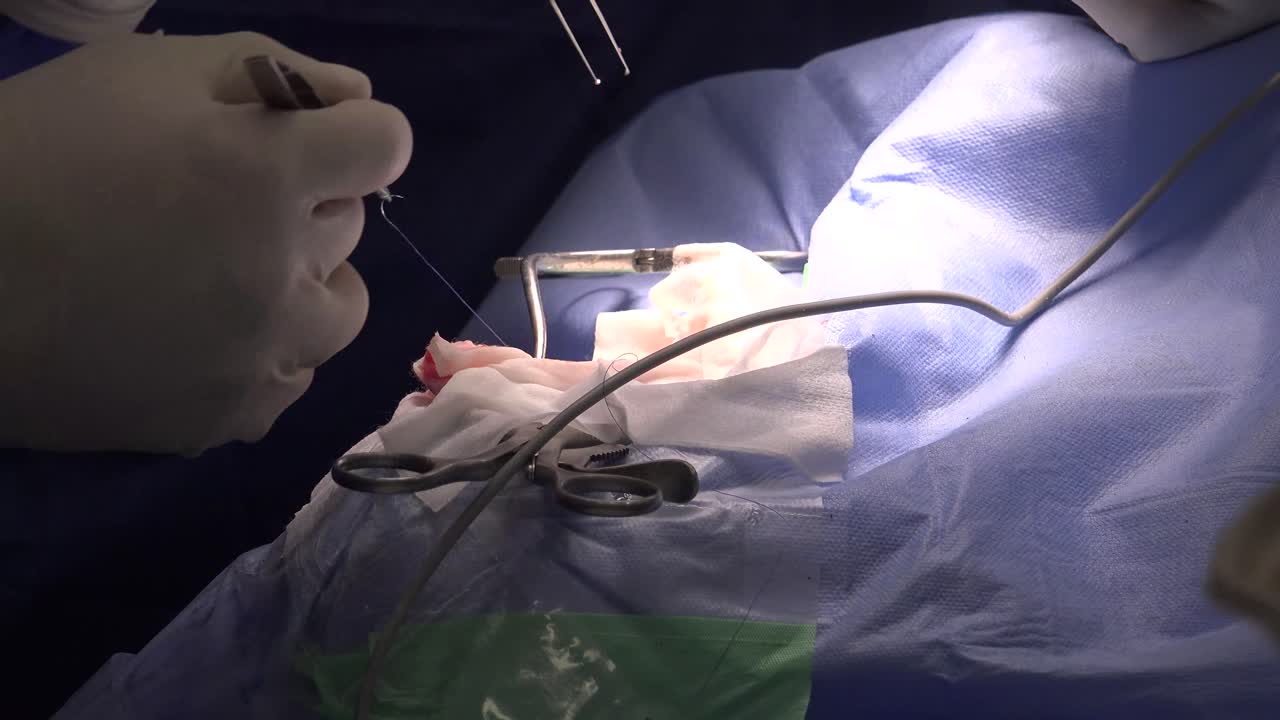 Understanding Hemifacial Spasm: Causes, Symptoms, Diagnosis, and Modern Treatment Approaches for Involuntary Facial Muscle Contractions Affecting One Side of the Face