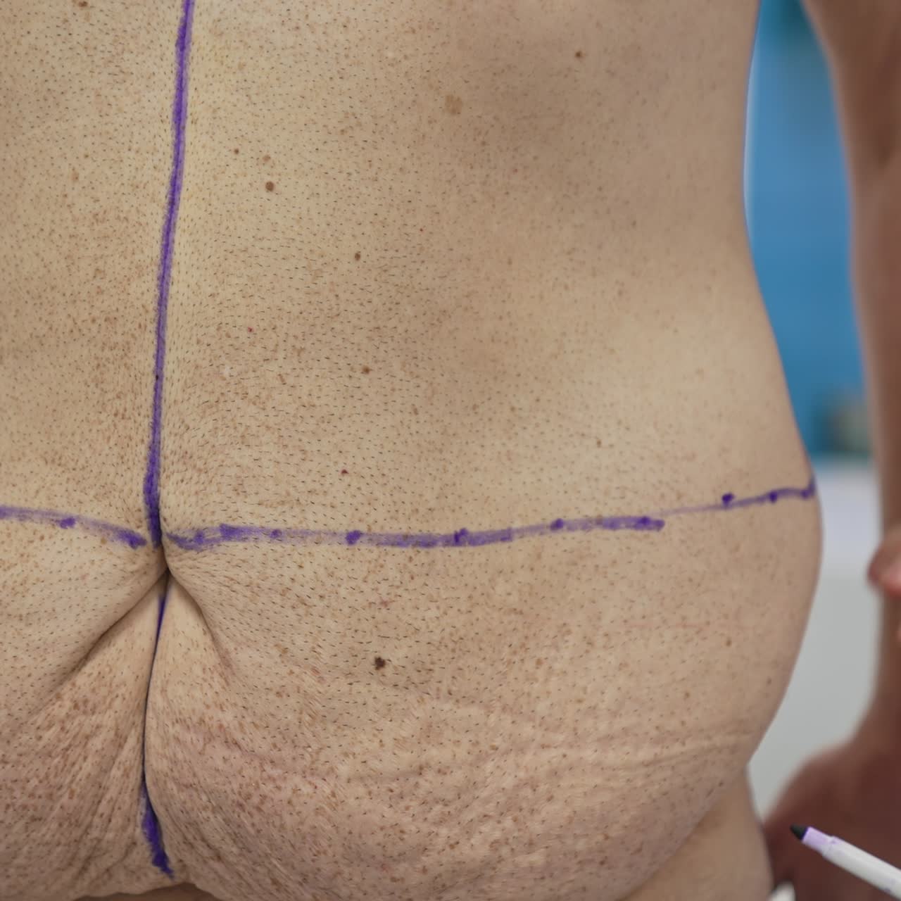 Unhealthy body of a man with problem parts. Doctor marks with a marker lines on patient's abdomen before the plastic surgery. Close-up