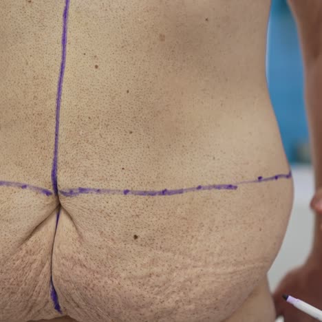 unhealthy body of a man with problem parts. doctor marks with a marker lines on patient's abdomen before the plastic surgery. close-up