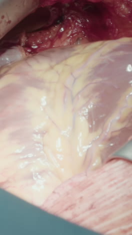 los retractores abren el pecho para la cirugía. los difusores de costillas abren el acceso al corazón para una cirugía exitosa de injerto de arteria coronaria. equipos médicos especializados