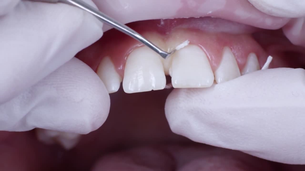 Dentist applying retraction cord between patient's teeth and gingiva